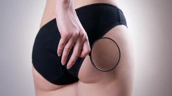 ¿Cómo eliminar la celulitis?