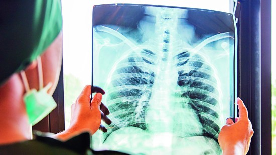 Radiografía de los pulmones
