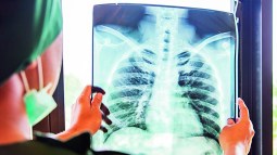 Radiografía de los pulmones